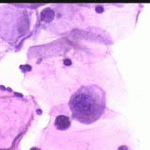 Κύτταρα κυρώς της επιφ. στοιβάδος με διακριτική κοιλοκυτταρωησ καιταση γιγαντιοκυτταρωσης